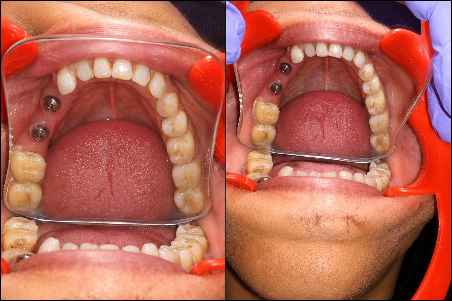 Dental Implants in Varanasi