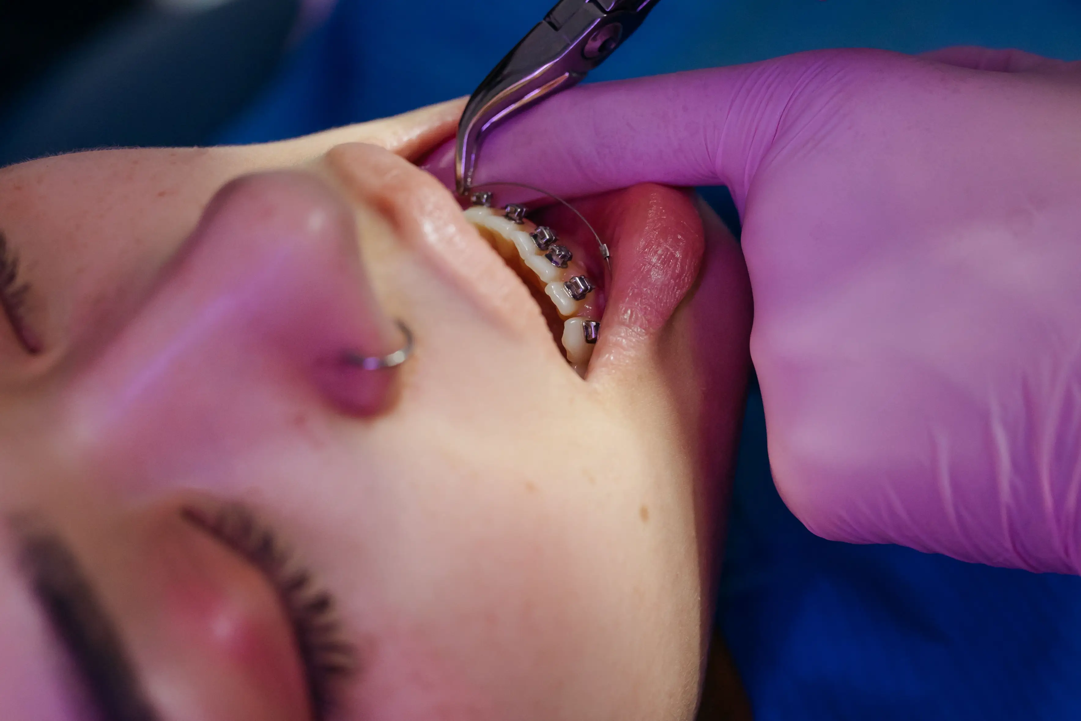 Intermaxillary Fixation