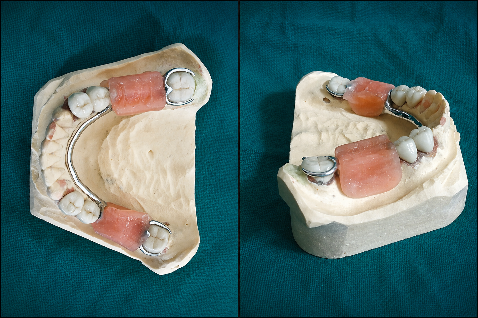Dental Implants in Varanasi