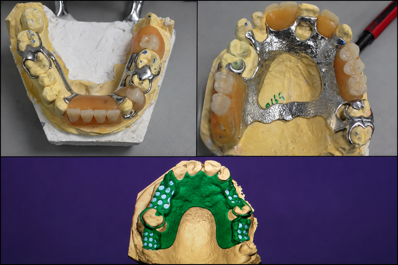 Dental Implants in Varanasi