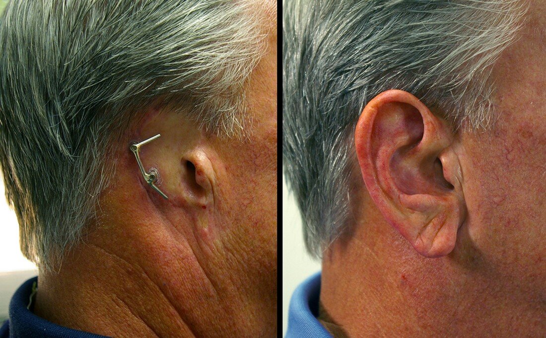 Clinical imagery of a custom silicone auricular prosthesis