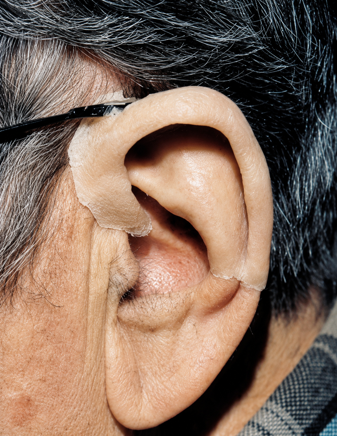 Auricular Prosthesis in Varanasi
