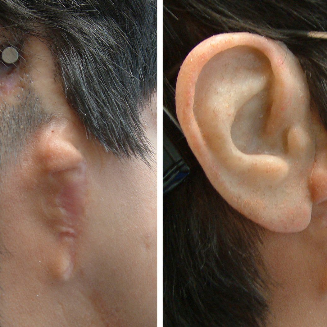 Auricular Prosthesis in Varanasi