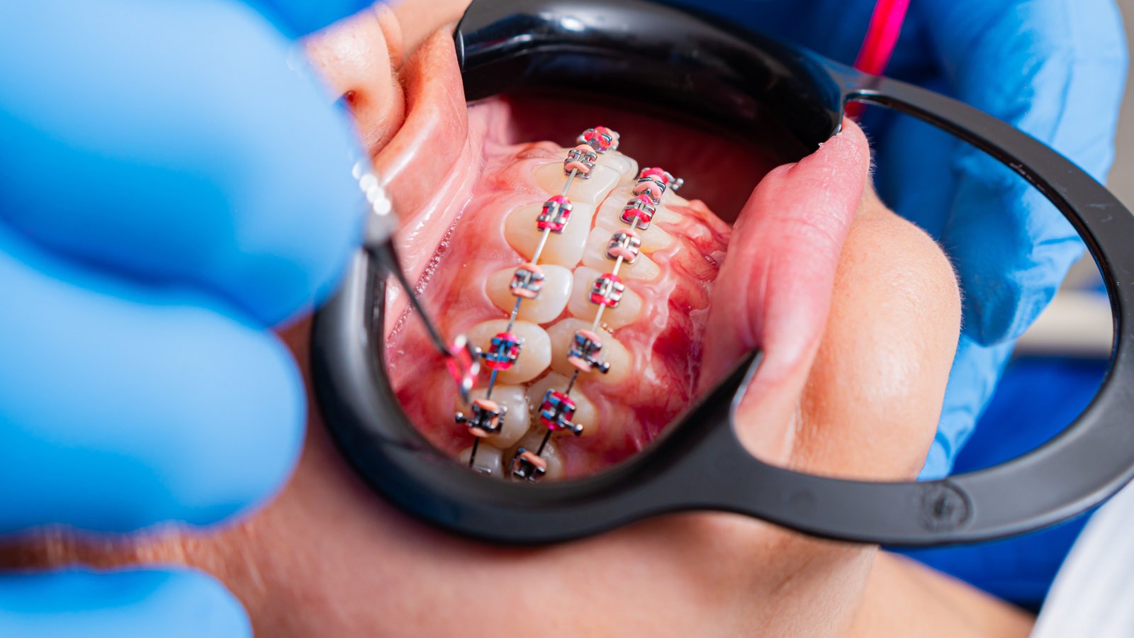 Close up of aesthetic ceramic braces on teeth