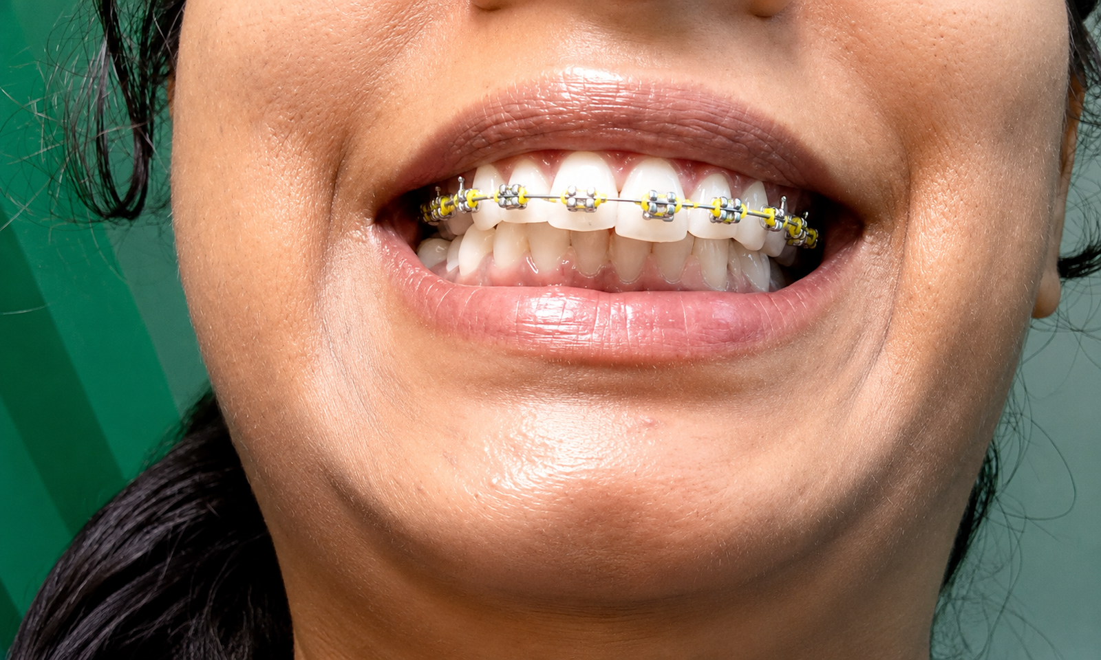 Dental Braces in Varanasi