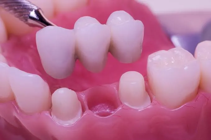 Dental Crowns and Bridges in Varanasi