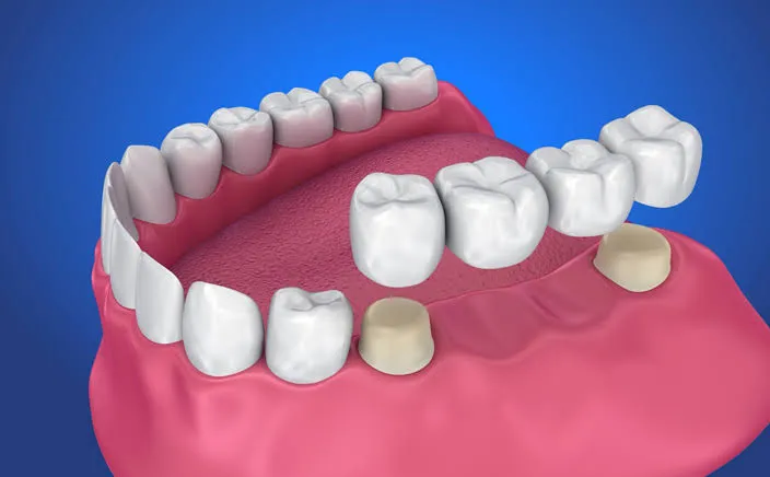 Dental Crowns and Bridges in Varanasi