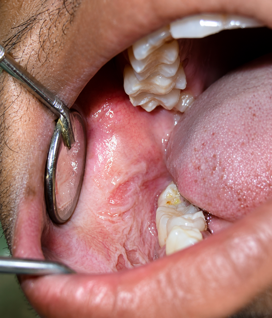Oral Cancer Care in Varanasi