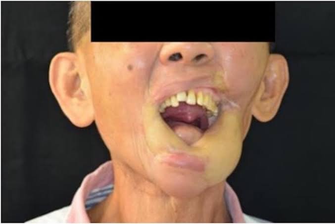 Clinical imagery of a post-oral cancer prosthesis