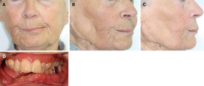 Oral Cancer Prosthesis in Varanasi