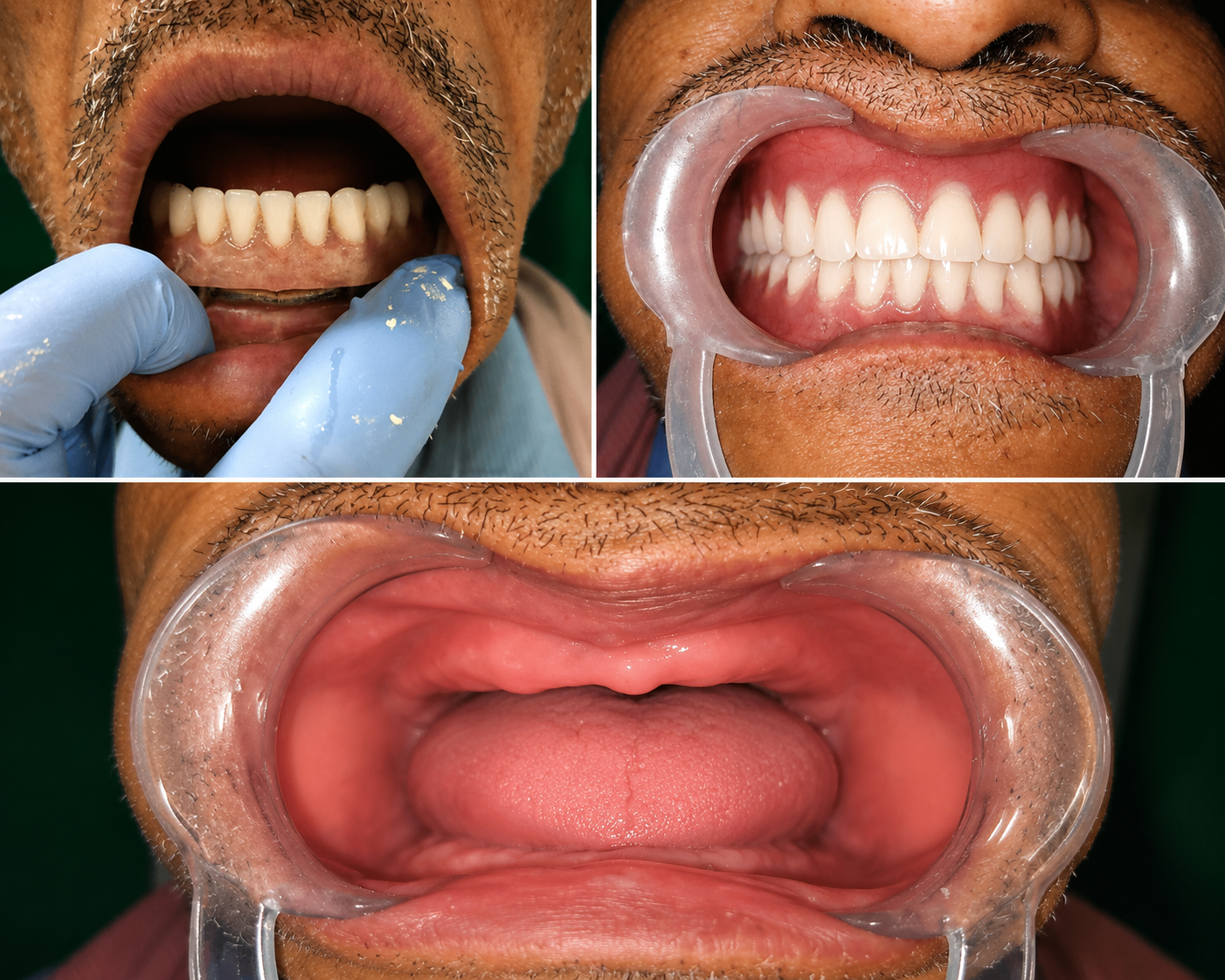 Dentures in Varanasi