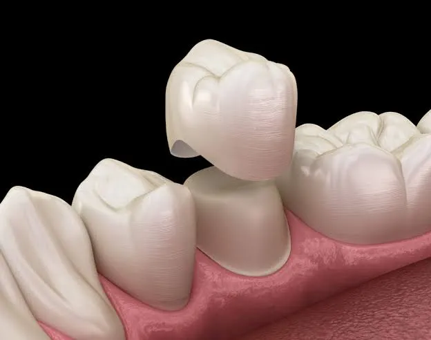Dental Crowns and Bridges in Varanasi