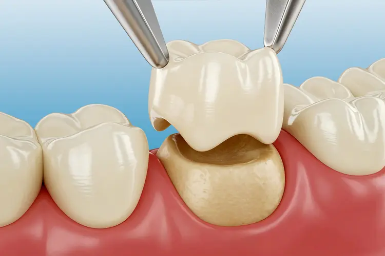 Dental Crowns and Bridges in Varanasi