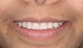 dentures-in-Varanasi