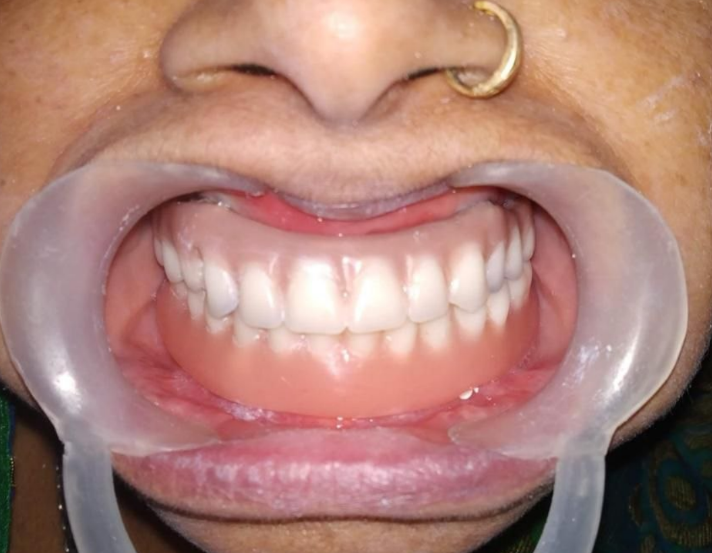 denturess-in-Varanasi
