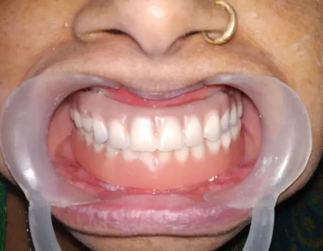 Dentures Guide