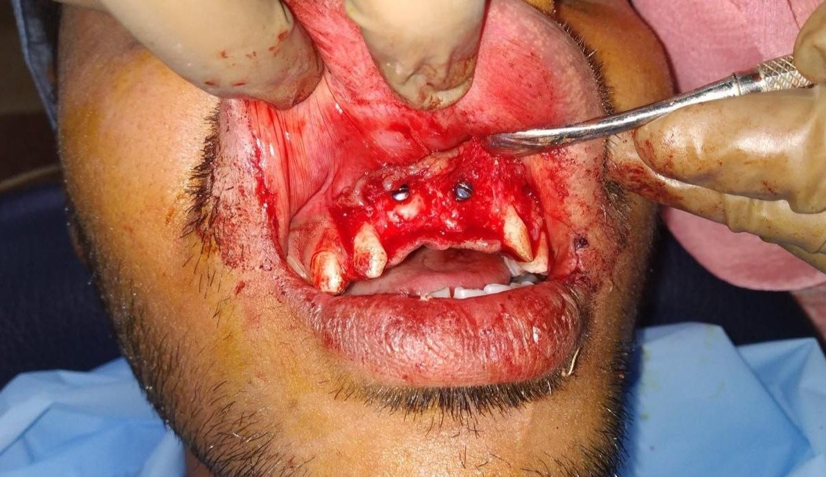 veneers-in-Varanasi