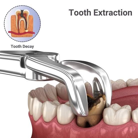 Dental Implants in Varanasi