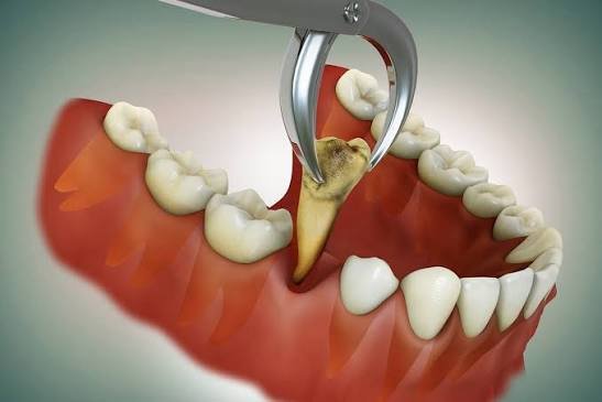 Clinical imagery of oral surgery and tooth extraction