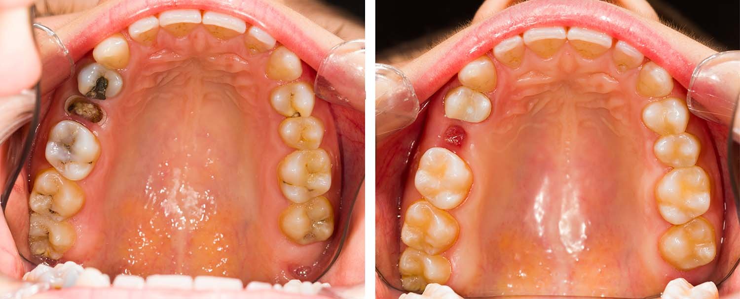 Dental Implants in Varanasi