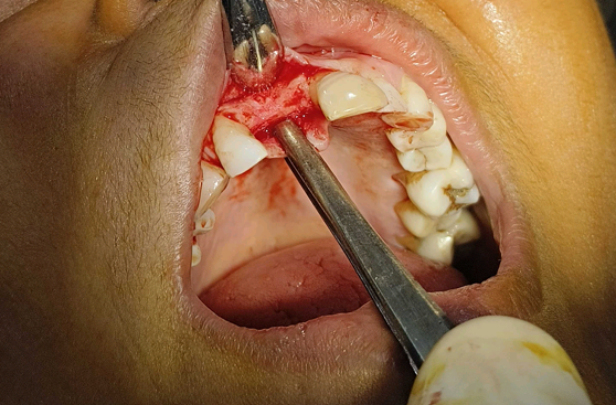 veneers-in-Varanasi