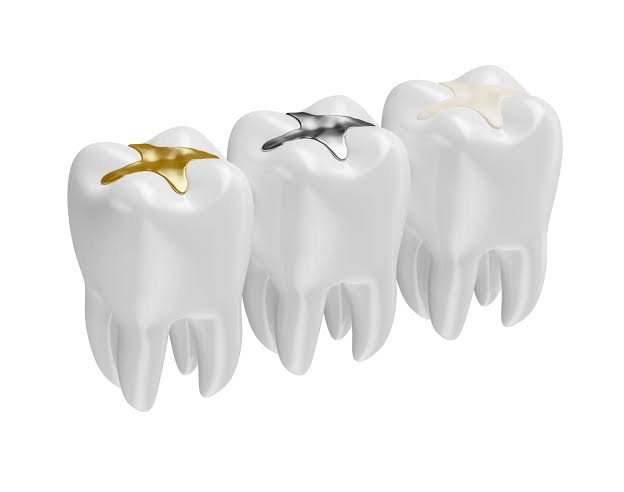 Close up of a tooth-colored composite filling being applied