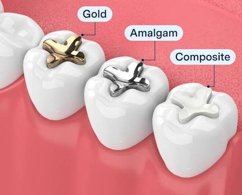 Dental Fillings in Varanasi