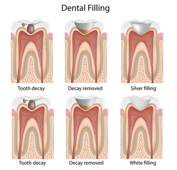 tooth fillings in Varanasi