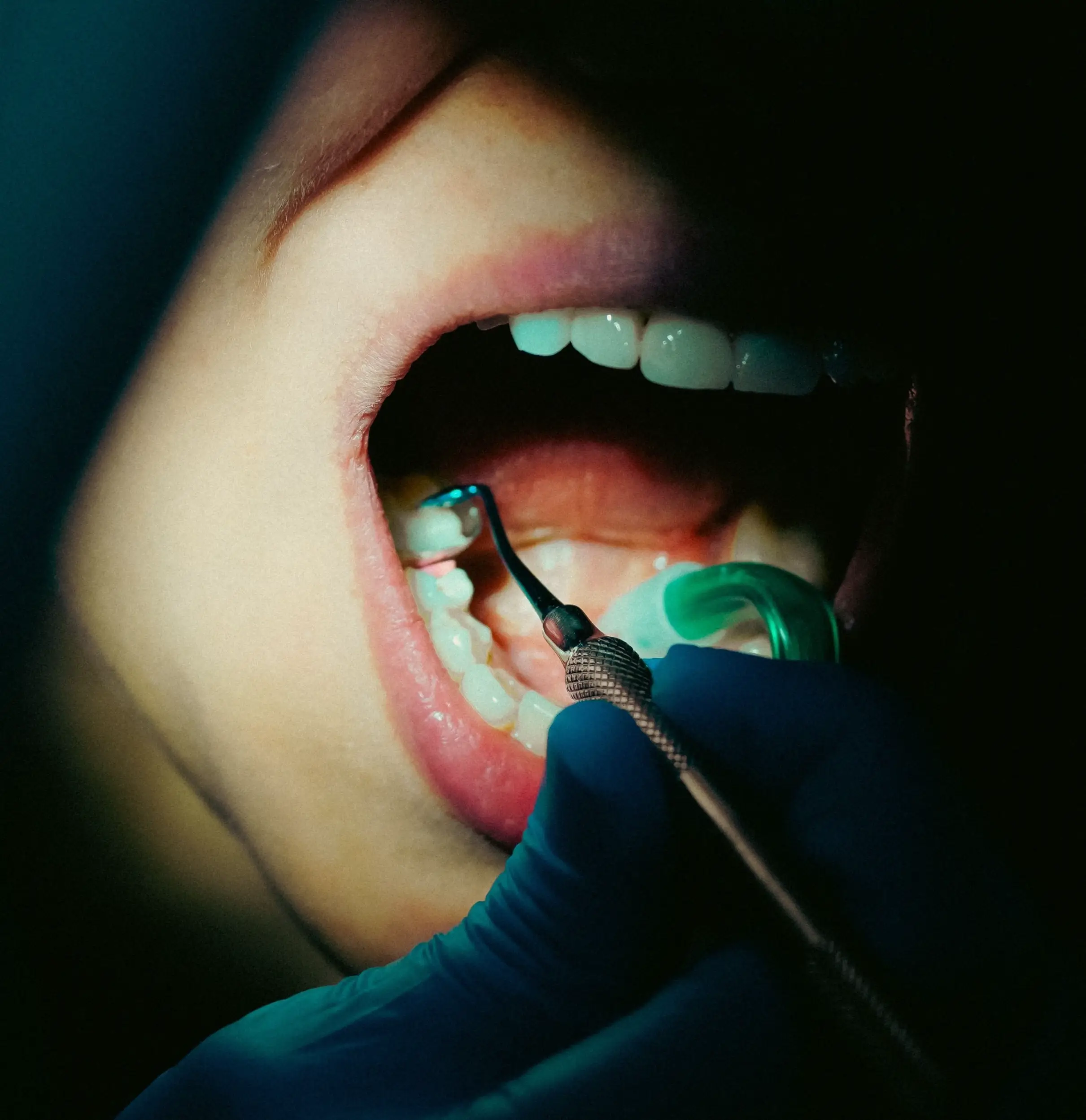 Tooth Fillings