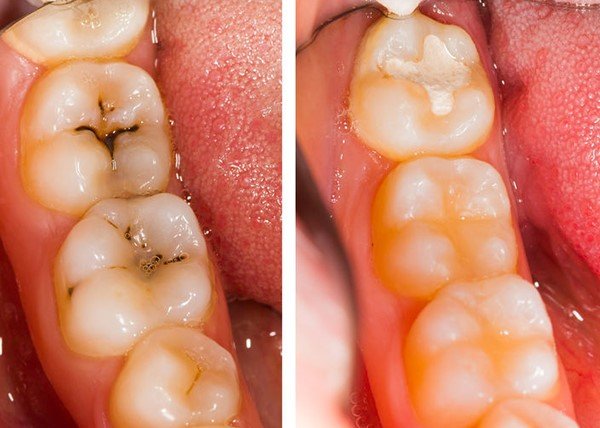 Fillings in Varanasi