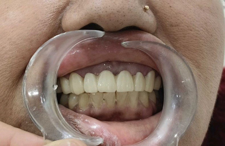 Dental Fixed Prosthesis in Varanasi