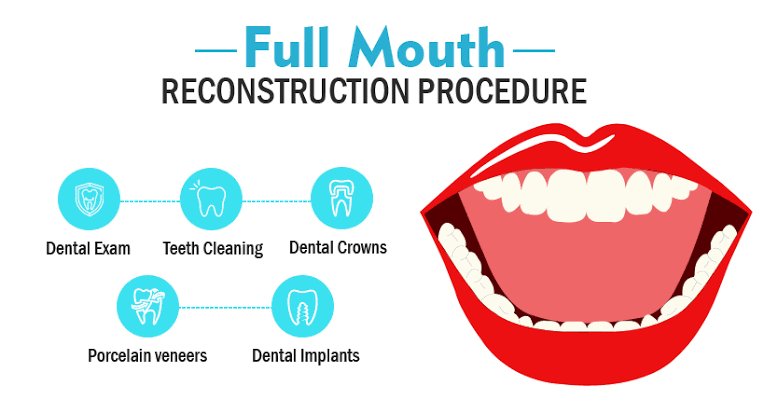 Full-mouth Rehabilitation in Varanasi