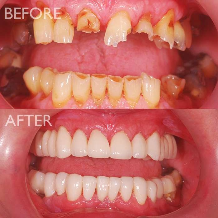 Full-mouth Rehabilitation in Varanasi