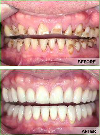 Full-mouth Rehabilitation in Varanasi