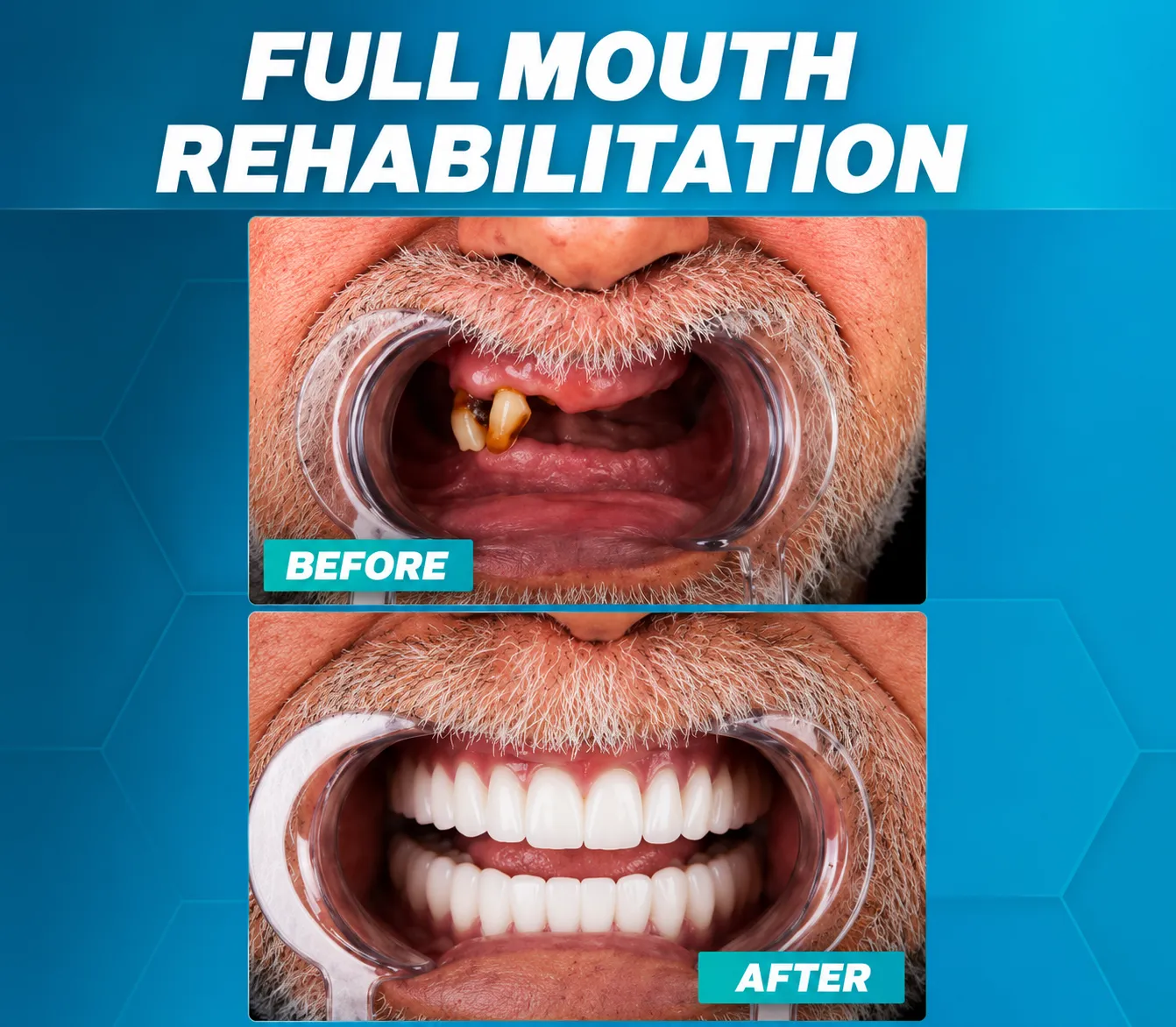 Full Mouth Rehabilitation