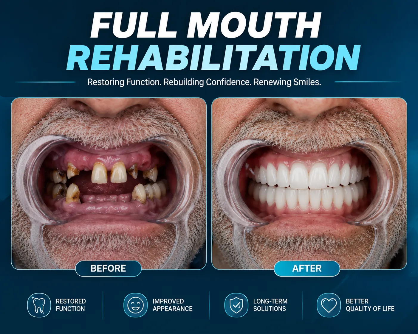 Full-mouth Rehabilitation in Varanasi