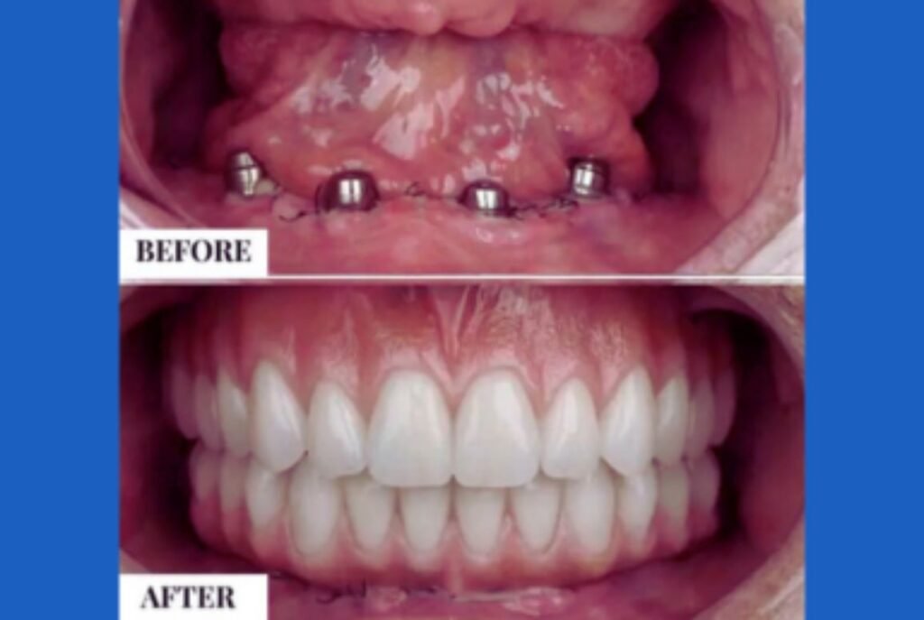 Full Mouth Rehabilitation