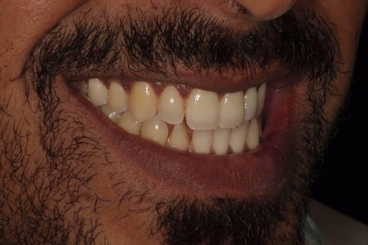 Dentures in Varanasi