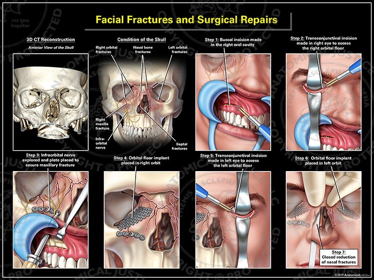 Dental Fractures Cure in Varanasi