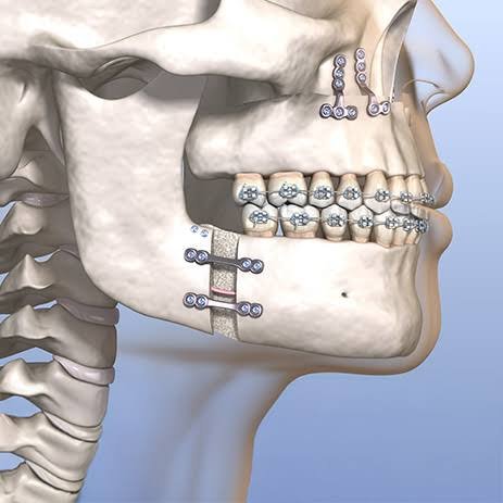 Dental Fractures Cure in Varanasi