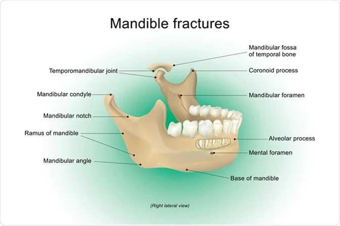 Dental Fractures Cure in Varanasi