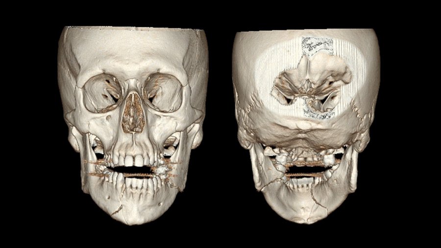 Dental Fractures Cure in Varanasi