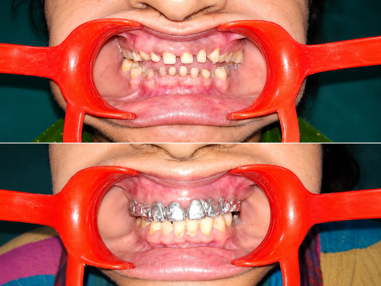 Full-mouth Rehabilitation in Varanasi