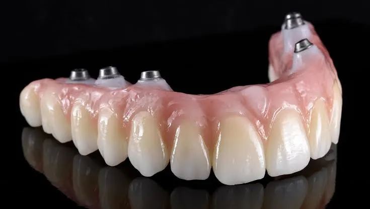 Dental Implants in Varanasi