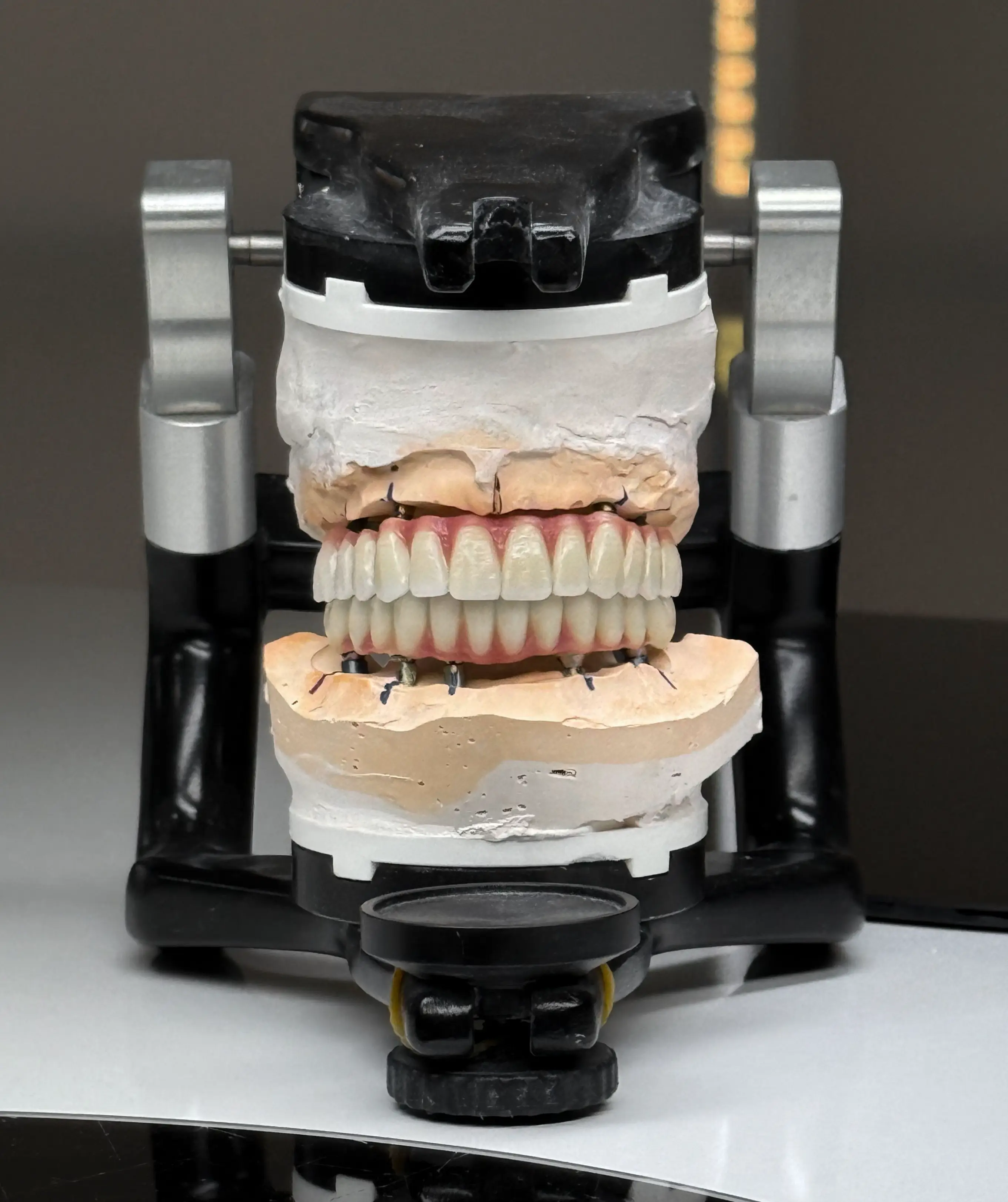 Hybrid Prosthesis