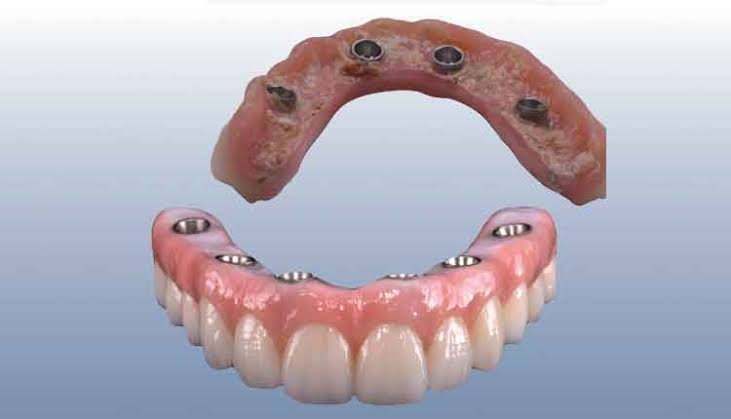 Dental Implants in Varanasi