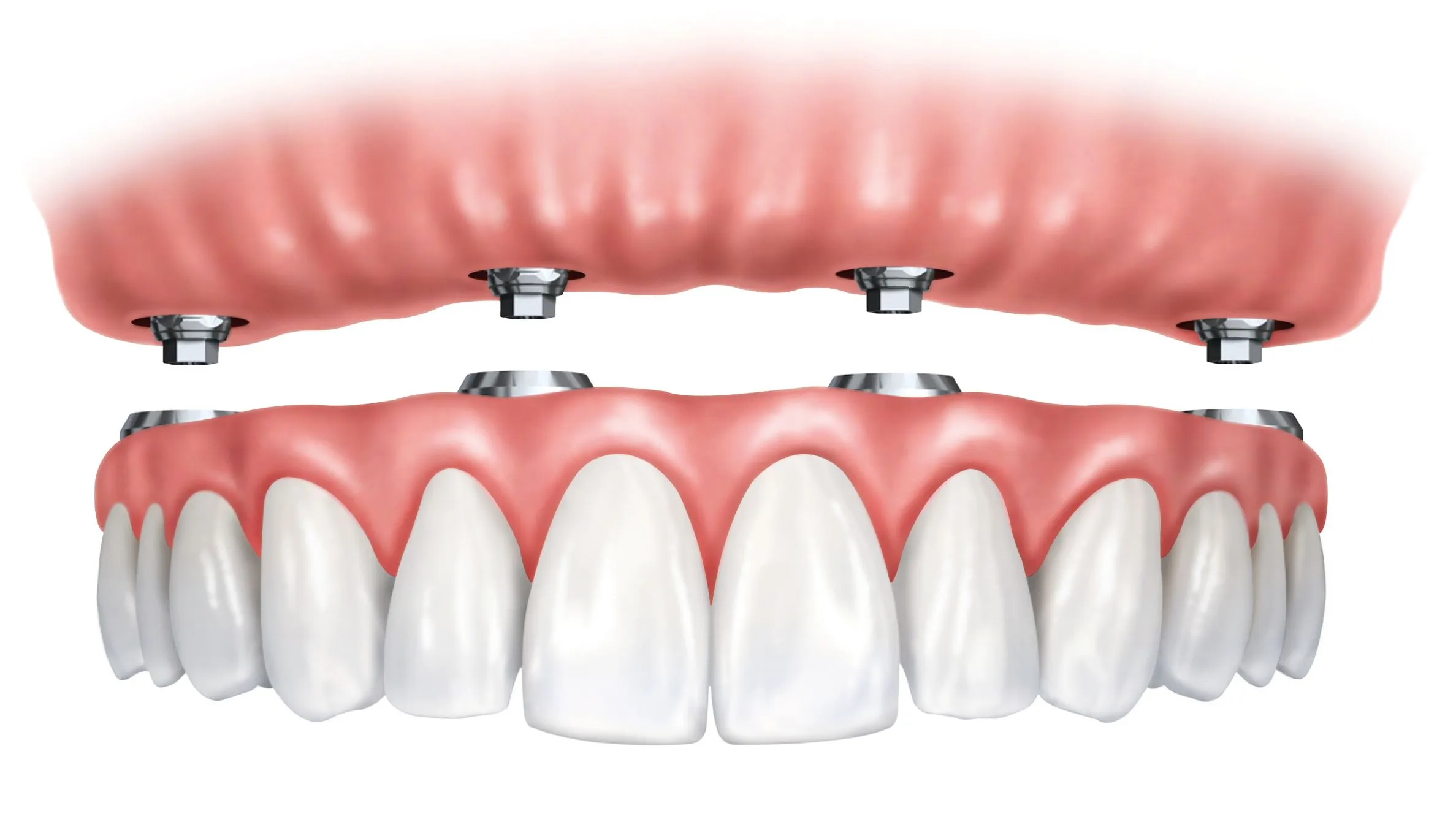 Dental Implants in Varanasi