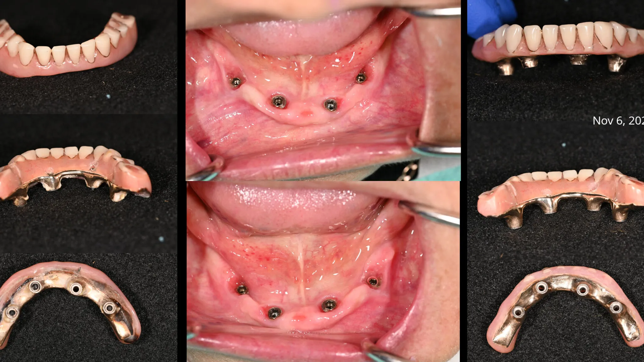 Dental Implants in Varanasi