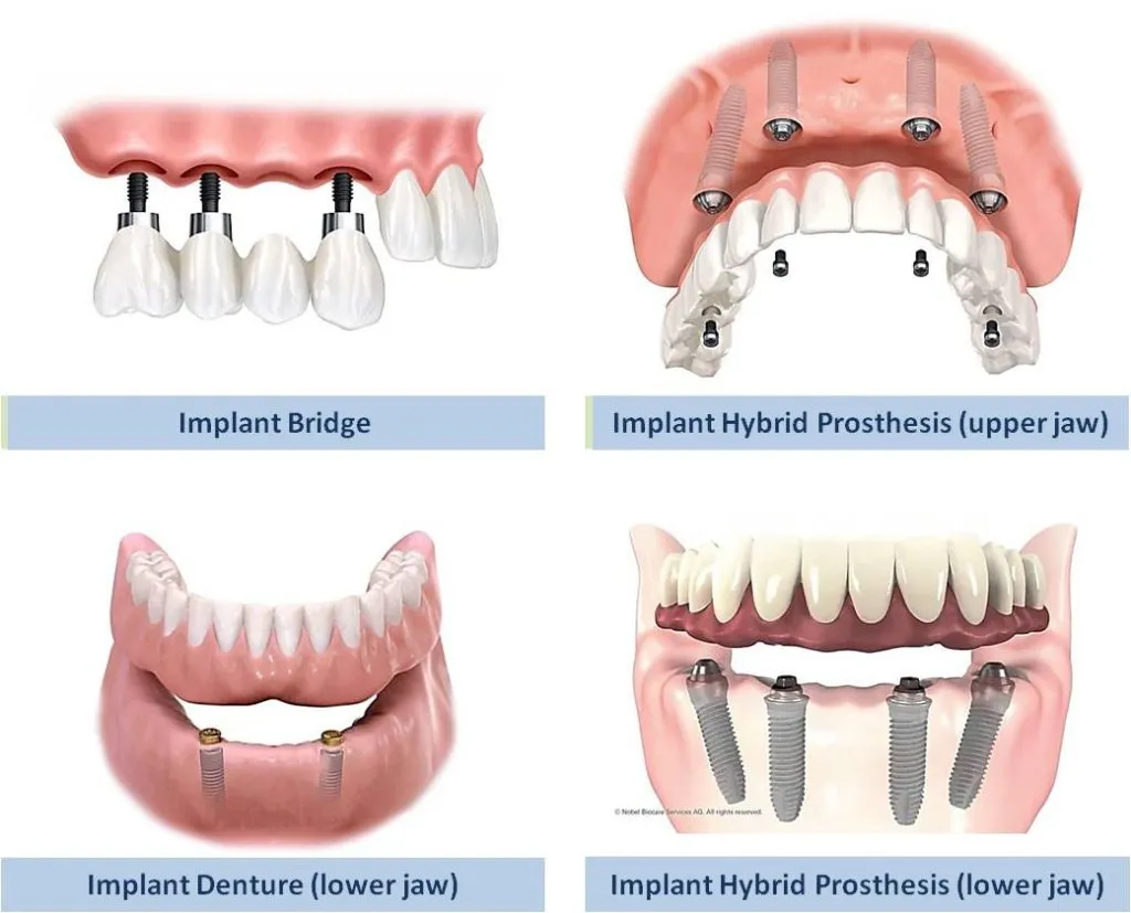 Dental Implants in Varanasi
