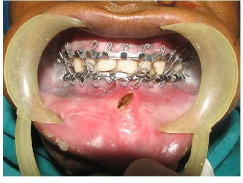 Clinical imagery of intermaxillary fixation and jaw wiring